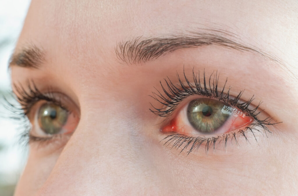 A close-up of eyes with very visible redness caused by dry eye syndrome.