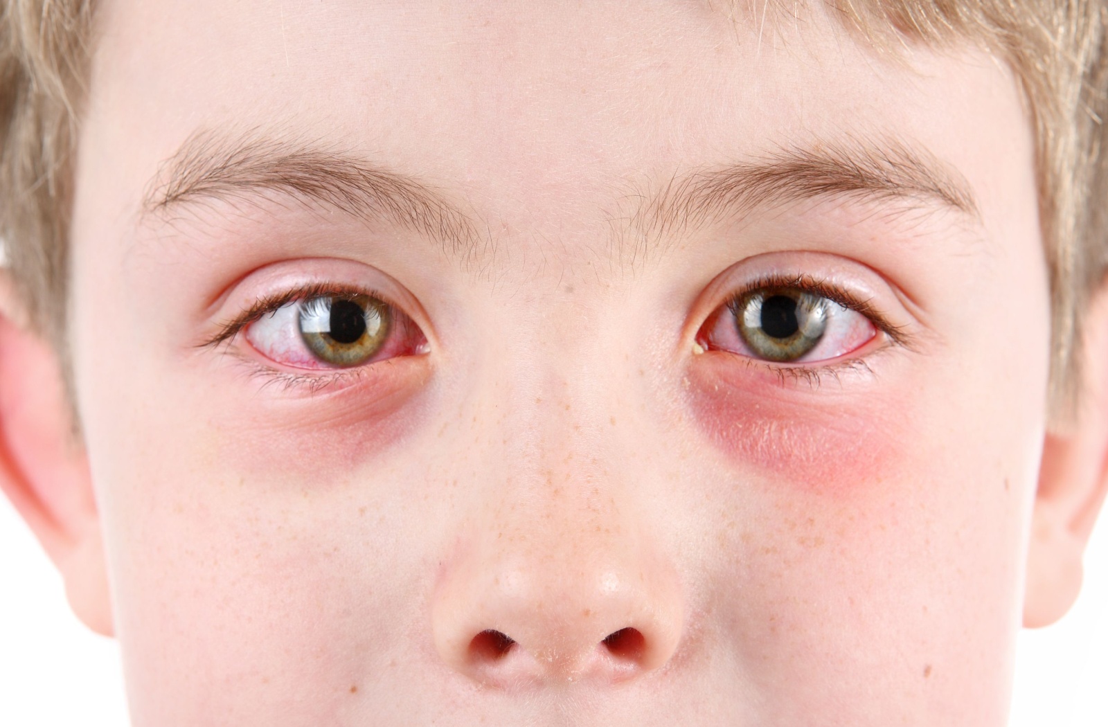 A close-up of a young boy's eyes that are red due to pink eye.