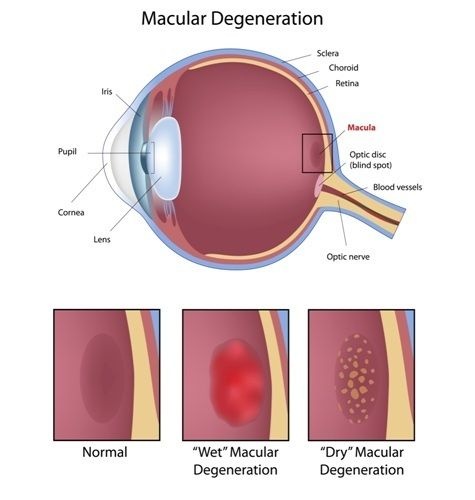 Medical diagram showing cross-section of eye with macular degeneration, including labeled anatomy and three comparison images showing normal macula, wet macular degeneration, and dry macular degeneration stages.