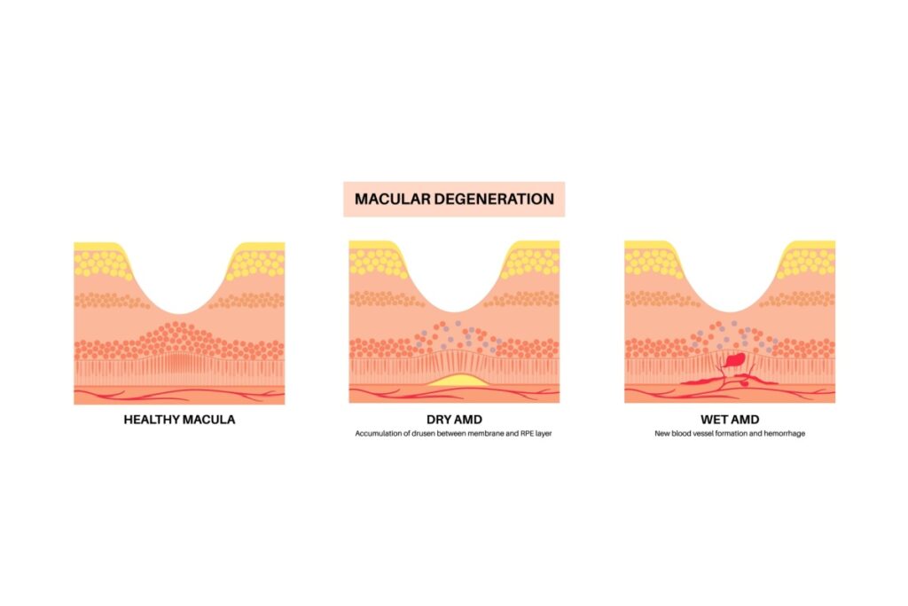 Illustration cross section of healthy macula vs with dry and wet AMD.