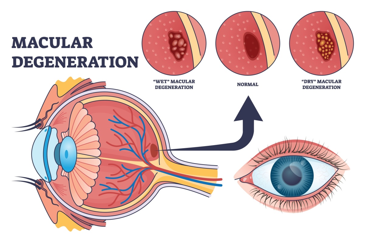Macular degeneration cross section illustration.