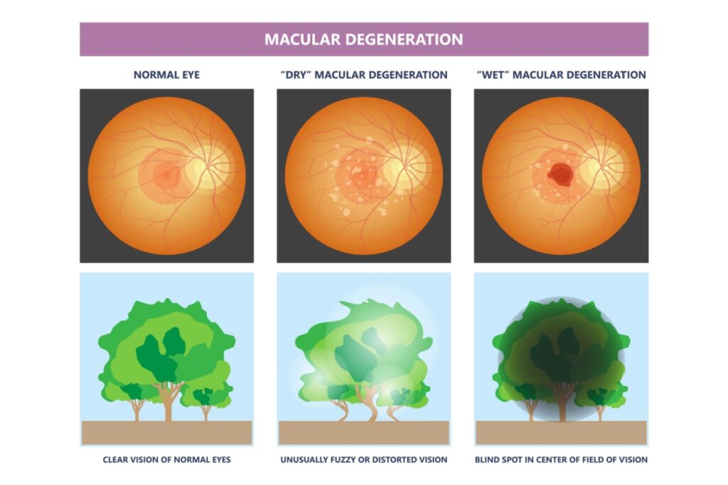 Normal vision compared to dry and wet amd illustration.