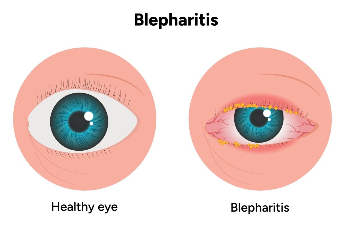 Comparison of a healthy eye and an eye with blepharitis showing red, inflamed eyelids with yellow crusts along the lashes.