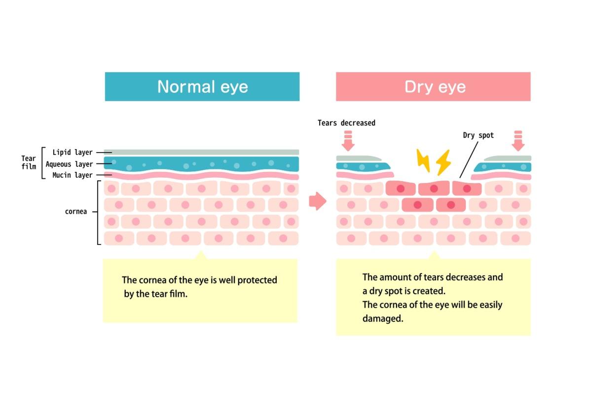 Diagram comparing a normal tear film protecting the cornea versus dry eye with reduced tears and a damaged, dry surface.